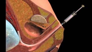 Chorionic Villus Sampling [upl. by Sayre]