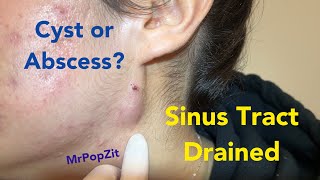 Sinus tract on face drained Cyst or acne nodule What do you think Very poppy [upl. by Eissim]