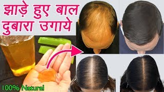 बालों को मोटा करें गंजेपन और बालो का गिरना कम करें Remedy for Hair Fall amp Baldness [upl. by Osnofla214]