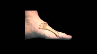 Midfoot Procedures 1st Met Cuneiform Exostectomy [upl. by Sheffie844]