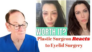 Plastic Surgeon Reacts  Lorry Hills Blepharoplasty Before amp After [upl. by Ziul762]