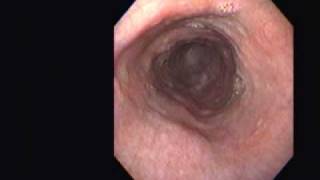 Achalasia Vs Pseudoachalasia [upl. by Ailama]