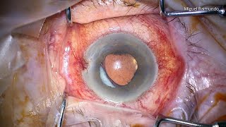 Late pseudophakic quotmalignantquot glaucoma [upl. by Putscher]