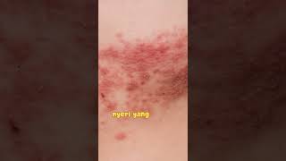 post herpetic neuralgia nyeri setelah kena herpes [upl. by Entsirhc]