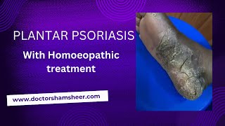 Plantar psoriasis [upl. by Garrett]