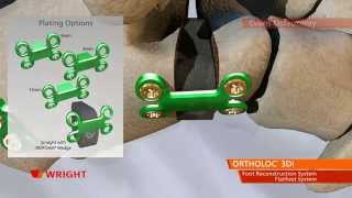 ORTHOLOC™ 3Di Foot Reconstruction System Flatfoot System Animation [upl. by Yelknirb404]