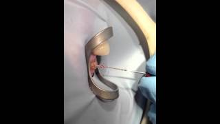 Dental Tooth Nerve removed live from Patient [upl. by Aimil125]