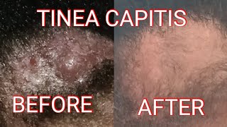 TINEA CAPITIS UPDATE [upl. by Ja]