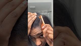 Remove Dandruff Naturally At Home  Get Rid Of DandruffShampoo Hack For Dandruff Removal shorts [upl. by Alodee]