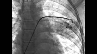 Arteriovenous pulmonary fistula [upl. by Mcnelly]