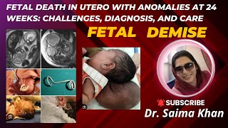 Fetal Death in Utero with Anomalies at 24 Weeks Challenges Diagnosis and Care drsaima khan case [upl. by Attecnoc]