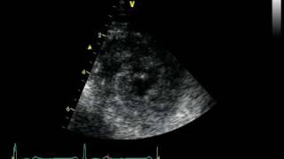 PARASTERNAL SAX VIEW at the level of apex  NORMAL STUDY [upl. by Suraved]