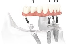 Dental Implant Osseointegration Process [upl. by Defant]