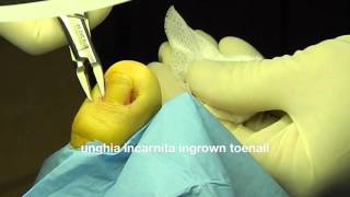 unghia incarnita  uña encarnada  ingrown toenail surgical treatment 向内生长趾甲 podologo [upl. by Leinahtam]