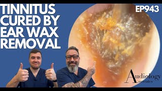 TINNITUS CURED BY EAR WAX REMOVAL  EP943 [upl. by Goer]