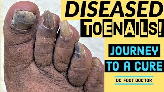 Diseased Toenails Journey To A Cure Trimming Fungal Toenails Onychomycosis [upl. by Steffin3]