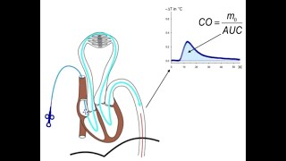 Is TPTD Transpulmonary Thermodilution Obsolete in context of POCUS [upl. by Kassi700]