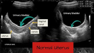 Normal Uterus and Ovaries  Ultrasound Case [upl. by Orvan391]