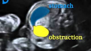 Fetal Medicine Foundation  Duodenal stenosis [upl. by Hirschfeld]