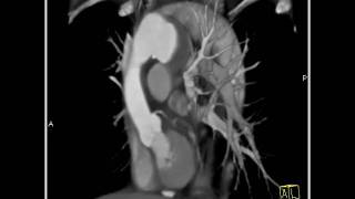 4D Imaging of the Aortic Valve Arch Pseudoaneurysm 8 of 8 [upl. by Htebesile42]