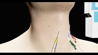 Spasmodic Dysphonia Treated with EMG Guided Botox Injection [upl. by Lizzie113]