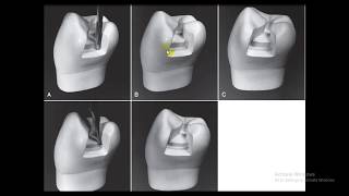 Class II amalgam restoration  Lec 5 [upl. by Naneek878]