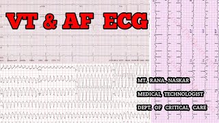 VENTRICULAR TACHYCARDIA amp ATRIAL FIBRILLATION ECG CRITERIAPATIENT FEATURESMT CCU [upl. by Leon663]