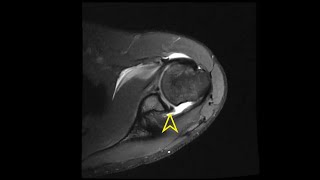 Shoulder MRI Bankart Lesion [upl. by Inoek164]