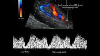 Ductus Venosus  Ultrasound [upl. by Asillam]