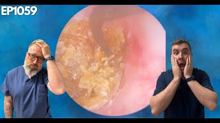 REMOVING THE MOST IMPACTED EAR WAX EVER  EP1059 [upl. by Stanford]