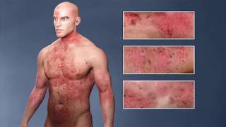 Atopic Dermatitis eczema From the Inside Out [upl. by Lemej]