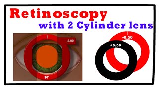 Retinoscopy with 2 Cylinder Trial Lenses Technique 3 [upl. by Fulton]