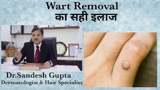 मससो Warts का सस्ता इलाज by Co2 laser treatment। Dr sandesh gupta Dermatologist Delhi9990804085 [upl. by Namsu]