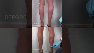 Transform Your Legs with Liposuction Before and After Results Revealed [upl. by Alyar772]