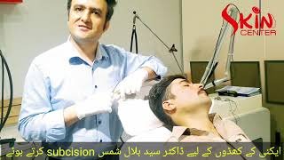 Acne scars treatment via Subcision by skin specialist Dr Syed Bilal Shams [upl. by Wachtel581]