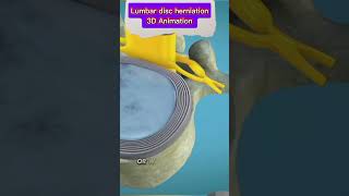 Lumbar Disc Herniation Causes Symptoms amp Treatment  Back Pain Reliefbackpain herniateddisc [upl. by Melville]