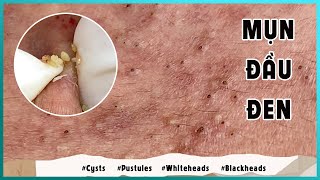 Big Cystic Acne Blackheads Extraction Blackheads amp Milia Whiteheads Removal Pimple Popping [upl. by Tita]