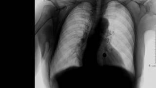 CASE 231 unilateral hypertranslucent left hemithorax X RAY [upl. by Arretnahs]