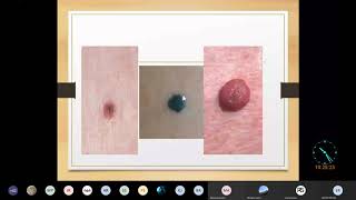 Nevus  Skin Pathology Complete  MBBS Lecture [upl. by Ahsilahk]