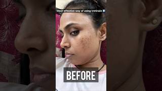 How to use Tretinoin Cream for most effective results Tretinoin before and after skin ✨shots [upl. by Neo577]