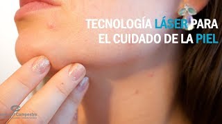 Tecnología láser para quitar manchas en la piel [upl. by Lledniw]