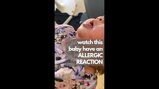 Watch This Baby Have an Allergic Reaction [upl. by Urbanus]