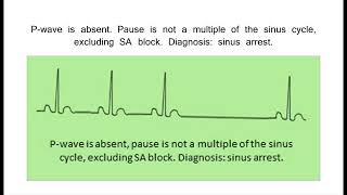 13 Sinus Node Dysfunction [upl. by Germayne275]