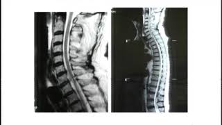 Post traumatic c7 t1 spondylolisthesis surgical treatment  Dr Massimo Balsano [upl. by Irak421]