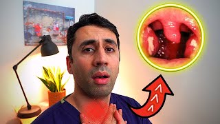 What Causes a Sore Throat HOME Remedies and Cures for Fast TREATMENT Doctor Explains [upl. by Nareht801]