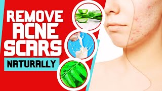 How to Remove Acne Scars Naturally [upl. by Louisa]