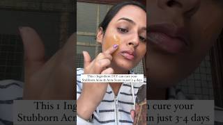 Acne Treatment at home  Remove Acne amp Acne Scars at home  Pimples treatment at home acnetreatment [upl. by Widera]