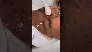 blackheadwhiteheadtreatmentsbotmaggotremovalextractionhumanpimplepopping pimplesremoval [upl. by Nohj]