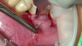 Modified Lateral Pedicle Flap for Augmentation of Keratinized Gingiva at Mandibular Molar IV [upl. by Yenahteb]