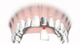 implantes dentales precios 2012  Consejos al Momento de Escoger implantes dentales precios 2012 [upl. by Erroll270]